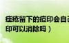 痤瘡留下的痘印會自己消失嗎（痤瘡留下的痘印可以消除嗎）