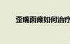 歪嘴面癱如何治療（面癱如何治療）