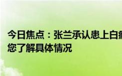 今日焦點：張?zhí)m承認患上白癜風(fēng)!“戰(zhàn)蘭”變“樂觀蘭”，帶您了解具體情況