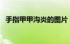 手指甲甲溝炎的圖片（大腳趾甲溝炎圖片）