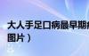 大人手足口病最早期癥狀（大人手足口最早期圖片）