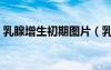 乳腺增生初期圖片（乳腺增生早期癥狀圖片）
