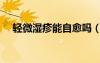輕微濕疹能自愈嗎（輕微濕疹圖片大全）