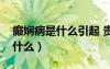 癲嫻病是什么引起 貴陽顛康位置（癲嫻病是什么）