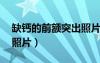 缺鈣的前額突出照片 頭顱（缺鈣的前額突出照片）