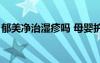 郁美凈治濕疹嗎 母嬰護(hù)理（郁美凈治濕疹嗎）