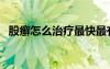 股癬怎么治療最快最有效（股癬怎么治療）