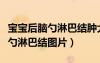 寶寶后腦勺淋巴結(jié)腫大是怎么回事（寶寶后腦勺淋巴結(jié)圖片）
