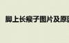 腳上長(zhǎng)瘊子圖片及原因（腳上長(zhǎng)瘊子圖片）